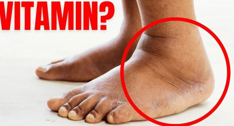 this-vitamin-removes-swelling-in-the-feet-and-legs-