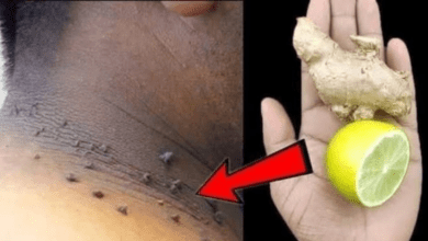 how-i-remove-skin-tags-at-home-with-lemon-and-ginger