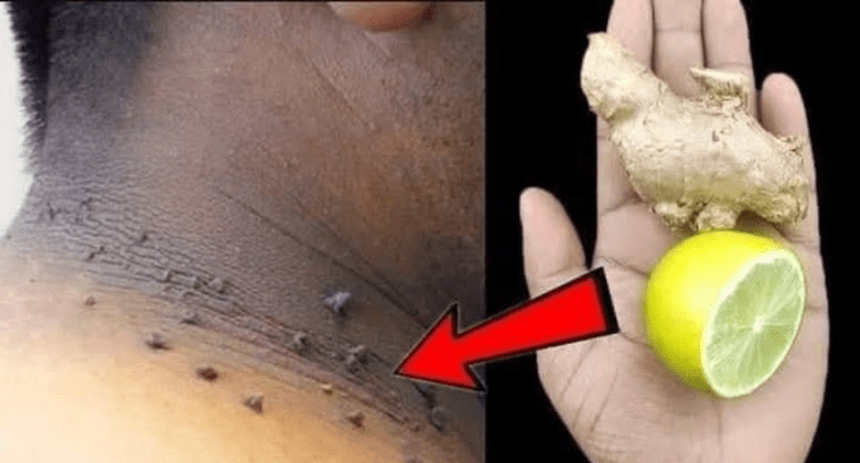 how-i-remove-skin-tags-at-home-with-lemon-and-ginger