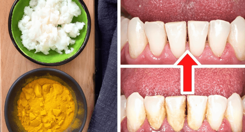 how-to-remove-tartar-and-plaque-from-your-teeth-without-a-dentist:-turmeric-and-salt