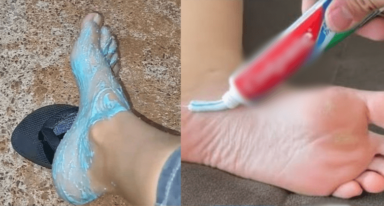 get-rid-of-cracked-heels-with-toothpaste:-a-simple-and-effective-remedy