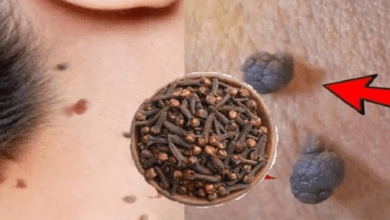 cloves-to-remove-skin-tags-and-warts-in-night:-a-natural-remedy