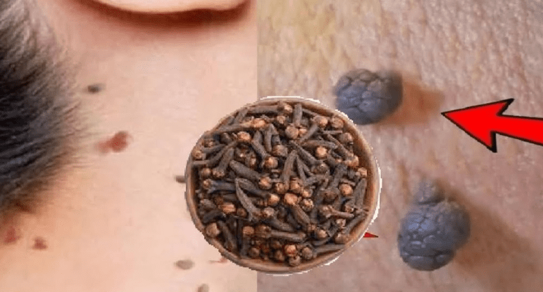 cloves-to-remove-skin-tags-and-warts-in-night:-a-natural-remedy