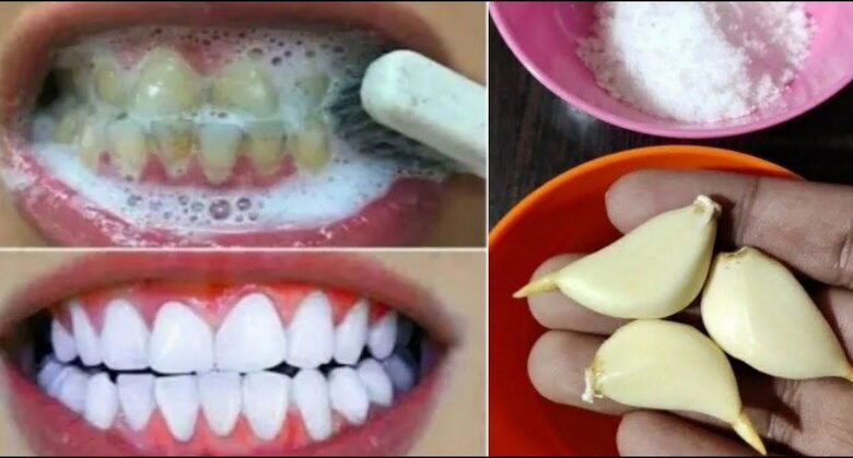 teeth-whitening-at-home:-how-to-naturally-whiten-yellow-teeth-with-garlic-and-baking-soda