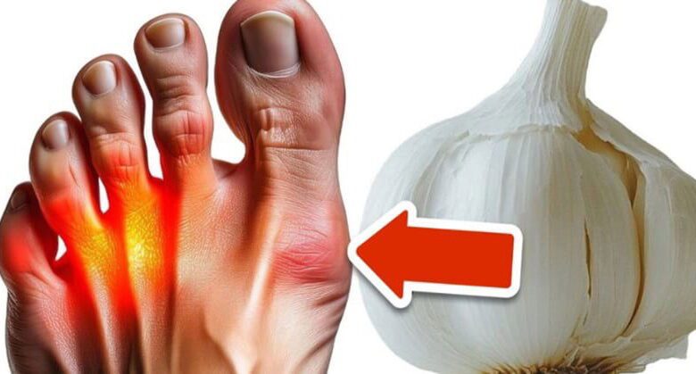 the-surprising-power-of-garlic-in-eliminating-gout