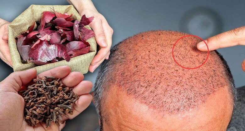 the-surprising-hair-growth-benefits-of-cloves-and-onion-peels