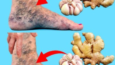 apply-this-mixture-before-bed-and-say-goodbye-to-varicose-veins