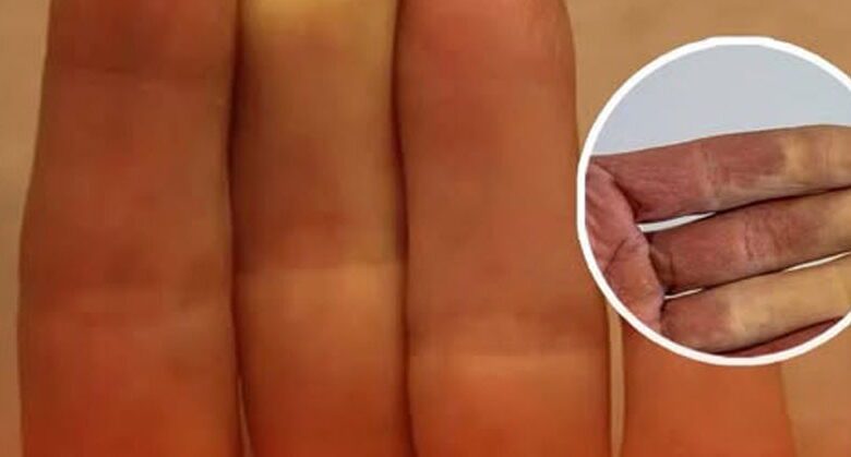 raynaud’s-phenomenon:-why-fingers-turn-white-in-the-cold?-a-danger-sign-in-health?