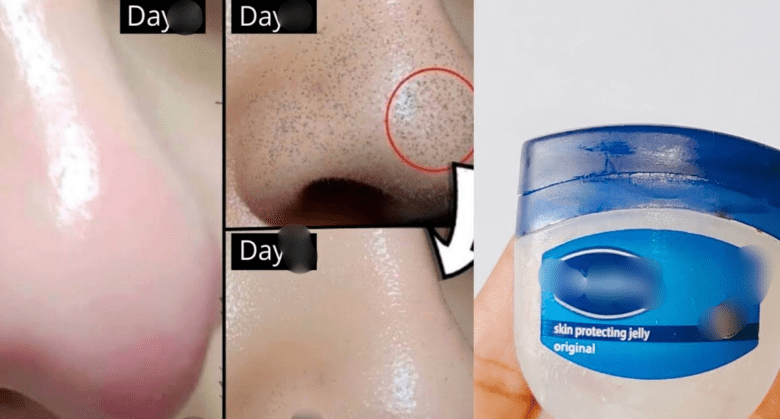 how-to-remove-blackheads-and-whiteheads-naturally-with-vaseline