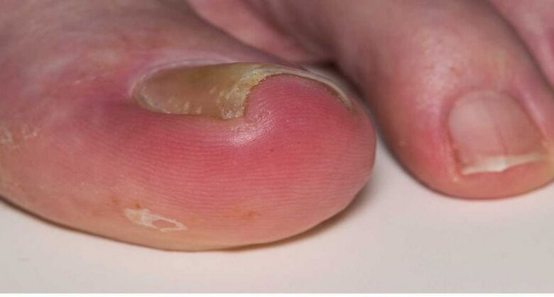 the-fastest-way-to-save-red-and-painful-toenail-edges