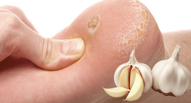 eliminate-plantar-warts-with-these-natural-garlic-remedies