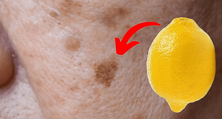 how-to-remove-age-spots-with-lemons