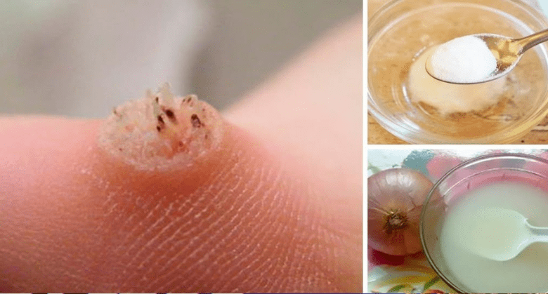 how-to-get-rid-of-warts-naturally-with-castor-oil-and-baking-soda