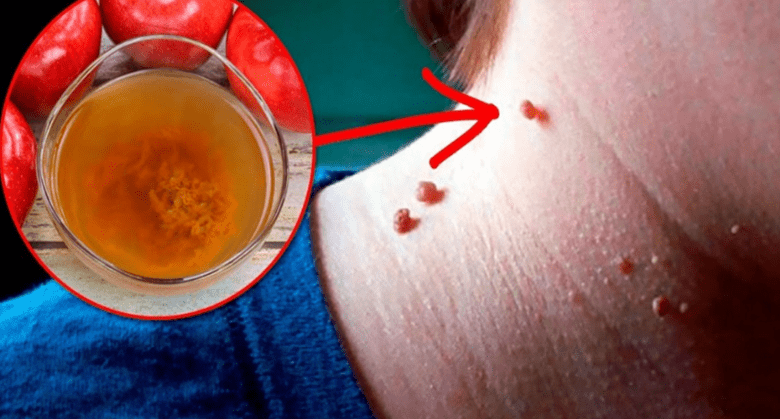 how-to-remove-skin-tags-naturally-at-home-with-apple-cider-vinegar