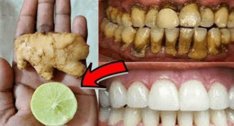 this-recipe-will-turn-yellow-teeth-white-like-pearls!-ginger-&-lime-teeth-whitening-hack