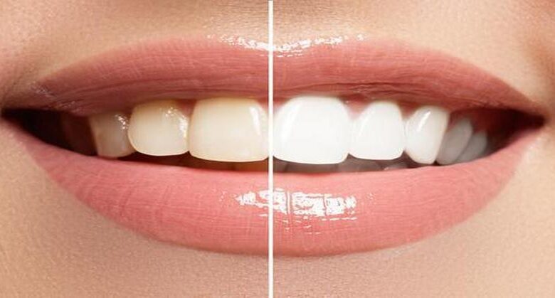 6-ways-to-safely-whiten-your-teeth