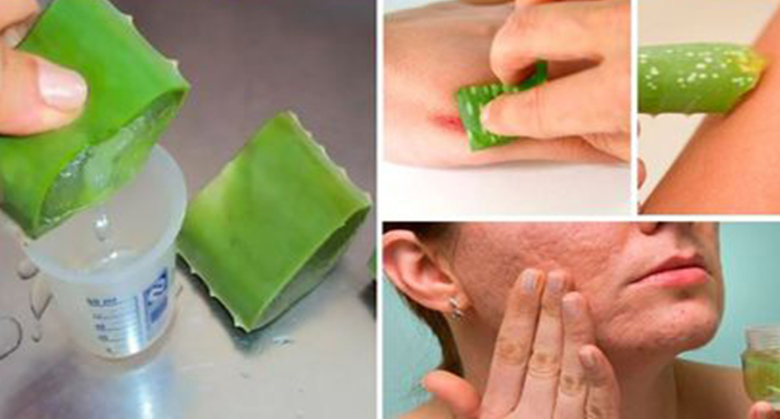 these-aloe-vera-face-masks-will-beat-your-acne-pimples-in-no-time