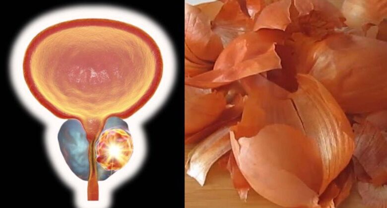 bladder-and-prostate-like-new!-grandpa’s-old-onion-peel-remedy