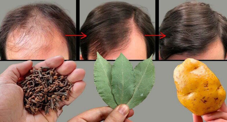 hair-growth!-bald-spots-disappear-with-this-craz.y-hair-growth-recipe!