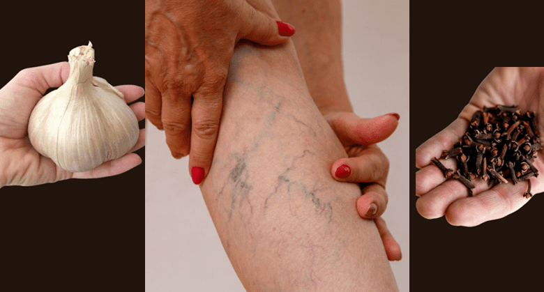 leg-pain,-rheumatism,-varicose-veins,-arthritis-–-natural-remedy-with-cloves-&-garlic!-