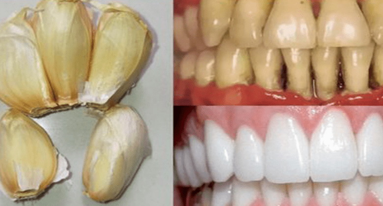 improve-your-oral-health-naturally-with-garlic