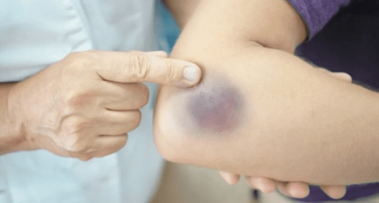 be-careful,-if-you-get-these-bruises-on-your-body,-here’s-what-it-means